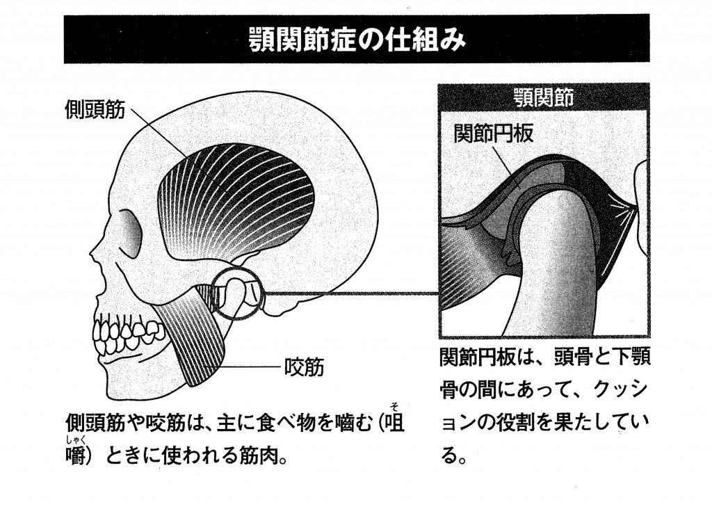 顎関節症に対するスプリント療法～簡便なスプリントの作製法と歯リハ２ ...